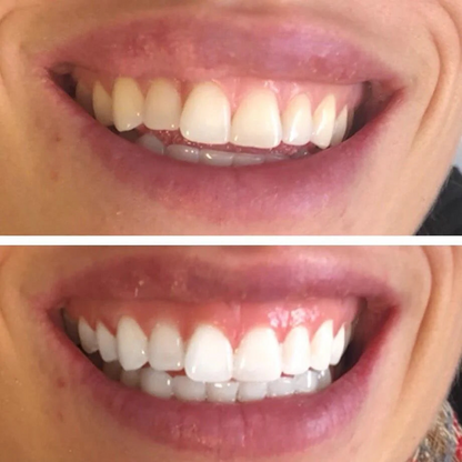 28 Bandes blanchissantes pour les dents