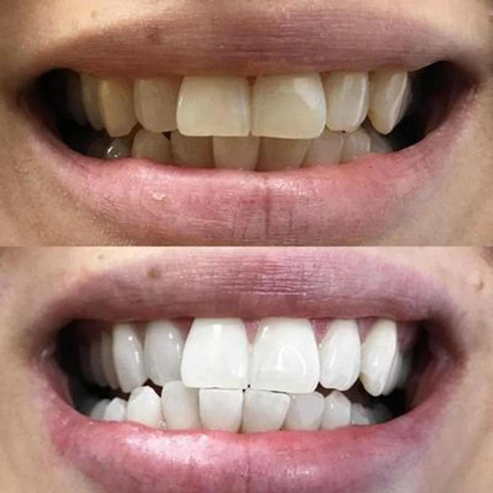 28 Bandes blanchissantes pour les dents
