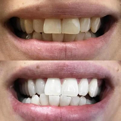 28 Bandes blanchissantes pour les dents